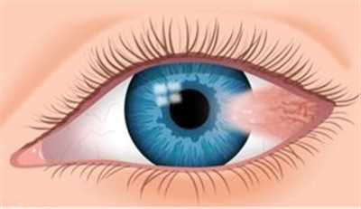 به زائده ای مثلثی شکل که از قسمت سفیدی چشم تا قرنیه و قسمت سیاه چشم کشیده می شود ناخنک چشم در شیراز گفته می شود. بدیهی است که این عارضه یک نوع زائده توموری است. اما در رده زائده های خوش خیم قرار می گیرد و قابل درمان است. خوشبختانه این عارضه با وجود ماهیت توموری که دارد سرطانی نیست. خارج کردن آن از چشم به آسانی صورت می گیرد.  
