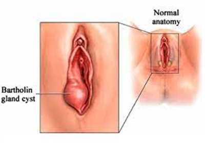 به طور کلی غده های بارتولون دو غده ترشحی و مخاطی هستند که به عنوان یکی از اجزای دستگاه تناسلی زنان نام برده می شود.
 این غده ها دارای اندازه بزرگی نیستند و می‌توان گفت که تقریباً به اندازه نخود می ‌باشند و نمی توان در حالت عادی یا بدون دستگاه‌های خاص آن ها را مشاهده کرد. این غده ها در زیر پوست ناحیه تناسلی و در دو طرف چپ و راست ورودی واژن قرار گرفته اند.