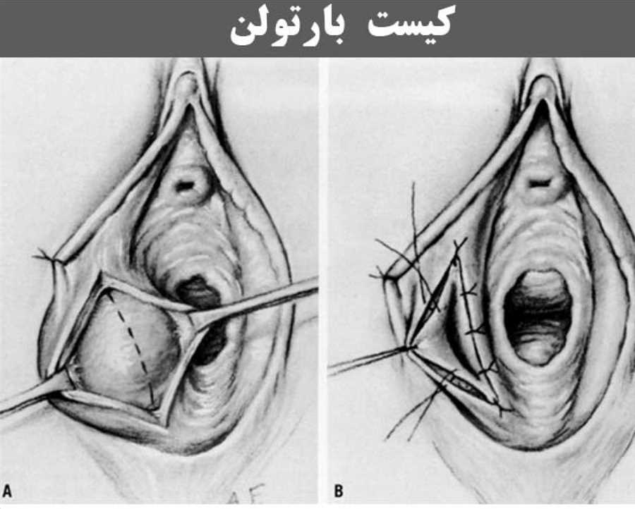 جراحی غده بارتولن شیراز | سینا پزشک