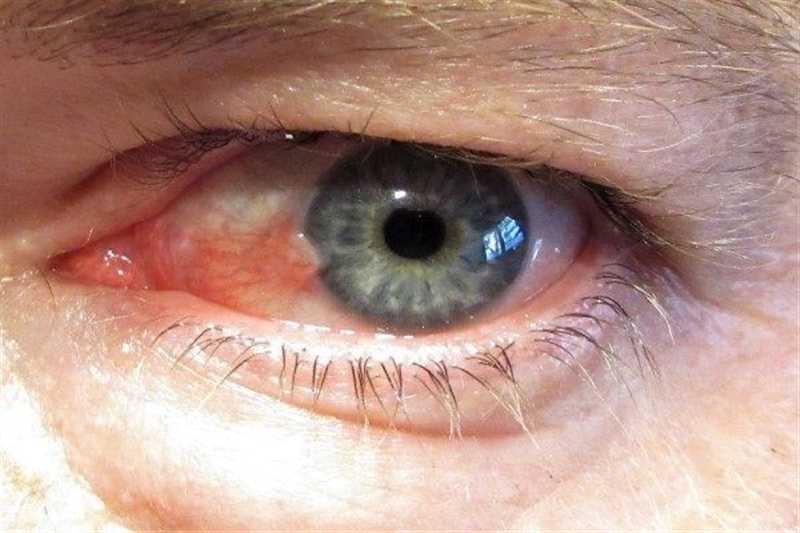 3 روش درمان ناخنک چشم در شیراز، علایم،‌ هزینه و مراقبت های قبل و بعد عمل
