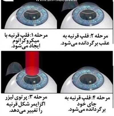 این جراحی به این صورت است که با استفاده از پرتو لیزر در شکل قرنیه چشم تغییر ایجاد می کنند و آن را اصلاح می کنند. تا زمانی که نور به چشم وارد می شود در جای مناسب و درستی از شبکیه متمرکز شود‌‌.
در بیشتر مواقع، جراحی لیزیک بدون بیهوشی و درد ناشی از جراحی بوده است.  حداکثر 15 دقیقه به طول انجامیده و نتایج بهبودی چشم بعد از 24 ساعت برای هر فرد نمایان شده است.  رهایی از هر گونه عینک و لنز را به ارمغان آورده است.
