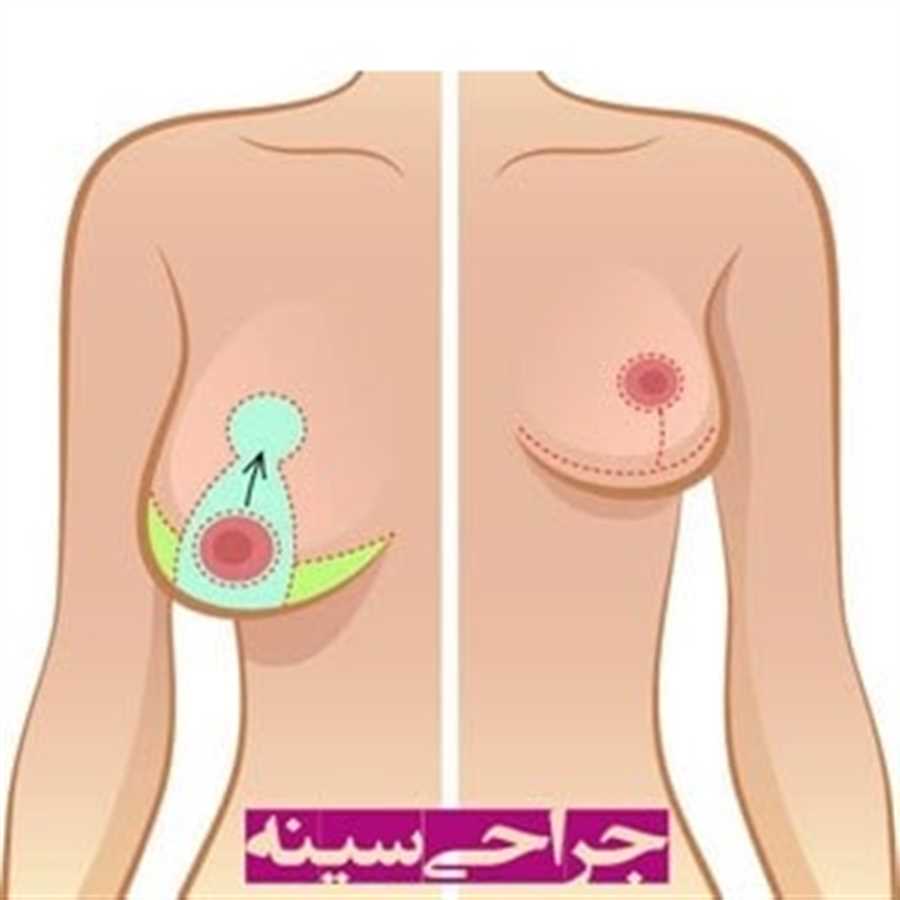 جراحی زیبایی سینه در شیراز