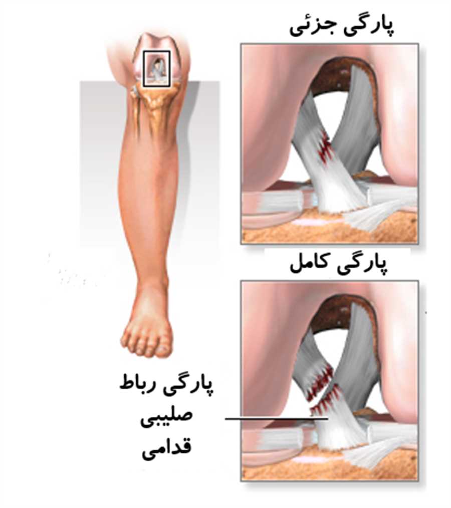 عمل رباط زانو در شیراز| سینا پزشک