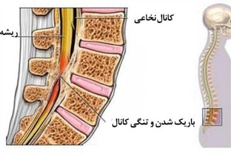 4 روش جراحی تنگی کانال نخاع در شیراز و مراقبت های بعد عمل