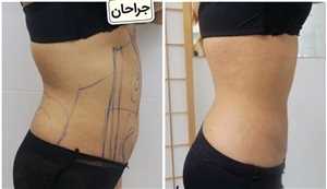7 نوع عمل لیپوساکشن در شیراز و مزایا و روش های انجام این جراحی