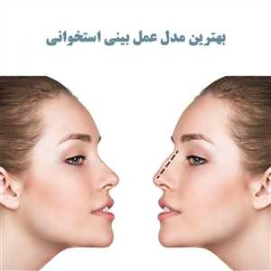 2 روش عمل بینی استخوانی در شیراز و مراقبت های قبل و پس از جراحی