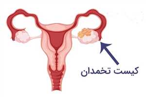 2 نوع جراحی کیست تخمدان در شیراز و توضیح کامل در مورد این عمل + هزینه و مراقبت ها