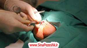 5 شرط انجام عمل وازکتومی در شیراز، کلیپ صفر تا صد جراحی + هزینه، مزیت های آن