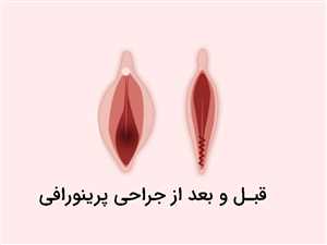 3 مزایای جراحی پرینورافی در شیراز + رابطه جنسی و مراقبت بعد از عمل