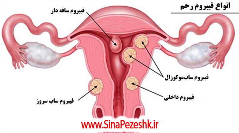 4 روش جراحی فیبروم رحم در شیراز و مزیت این عمل