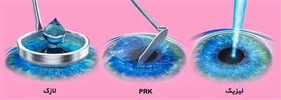  این عمل، یکی از بهترین و ایمن ترین عمل های جراحی لیزر چشم است که احتمال بازگشت شماره چشم در آن، بسیار کم است. در شیراز، پزشکان و متخصصان زیادی وجود دارد که می توانند عمل لازک چشم را به بهترین شکل انجام دهند.
