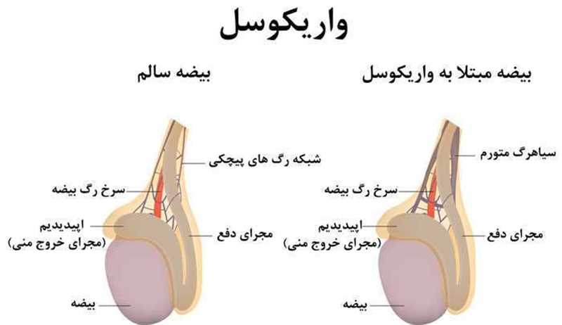 3 روش جراحی عمل واریکوسل در شیراز و 5 علایم آن