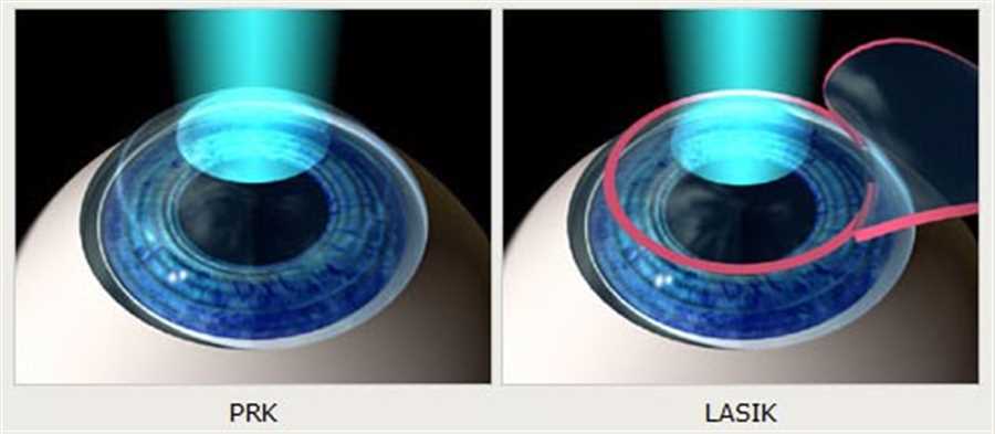 مقایسه عمل پی آر کی و لیزیک چشم در شیراز | سینا پزشک