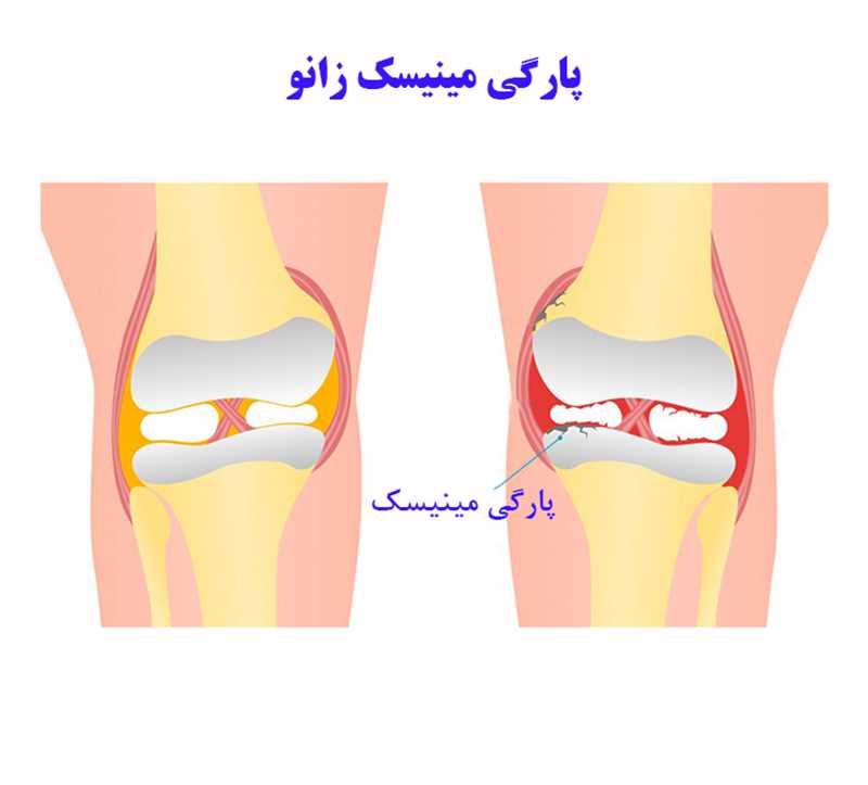 3 روش جراحی مینیسک زانو در شیراز و هزینه ی این عمل