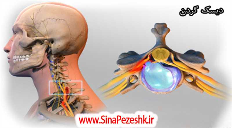3 روش جراحی دیسک گردن در شیراز و مراقبت های بعد از عمل