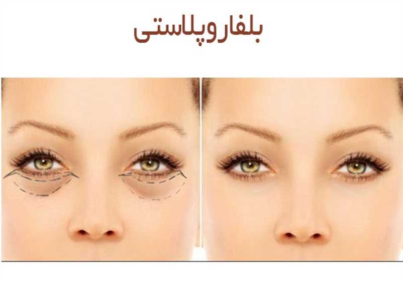 2 نوع روش جراحی پلک در شیراز و 7 توصیه قبل از عمل